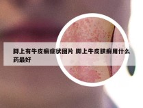 脚上有牛皮癣症状图片 脚上牛皮肤癣用什么药最好