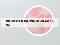 屏障修复能治银屑病 屏障修复过程会出什么状况