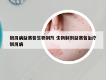 银屑病益赛普生物制剂 生物制剂益赛普治疗银屑病