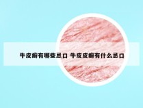 牛皮癣有哪些忌口 牛皮皮癣有什么忌口