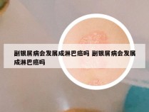 副银屑病会发展成淋巴癌吗 副银屑病会发展成淋巴癌吗