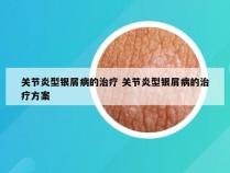 关节炎型银屑病的治疗 关节炎型银屑病的治疗方案