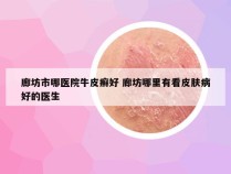 廊坊市哪医院牛皮癣好 廊坊哪里有看皮肤病好的医生