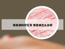 银屑病如何引发 银屑病怎么会得