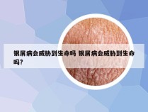 银屑病会威胁到生命吗 银屑病会威胁到生命吗?