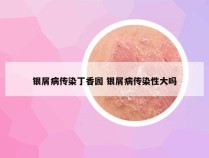 银屑病传染丁香园 银屑病传染性大吗