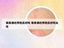 银屑病吃烤地瓜好吗 银屑病吃烤地瓜好吗女性