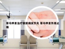 草乌甲素治疗银屑病关节炎 草乌甲素外用止痛