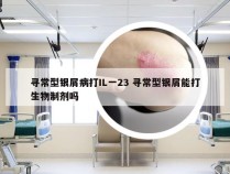 寻常型银屑病打IL一23 寻常型银屑能打生物制剂吗