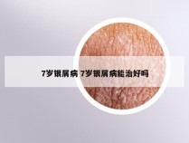 7岁银屑病 7岁银屑病能治好吗