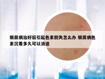 银屑病治好后引起色素脱失怎么办 银屑病色素沉着多久可以消退