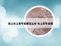 身上头上有牛皮癣怎么办 头上生牛皮癣