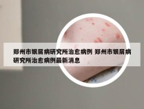 郑州市银屑病研究所治愈病例 郑州市银屑病研究所治愈病例最新消息