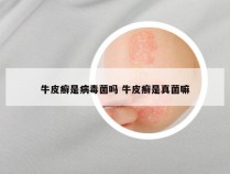 牛皮癣是病毒菌吗 牛皮癣是真菌嘛