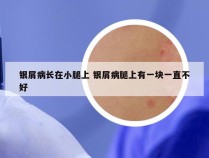 银屑病长在小腿上 银屑病腿上有一块一直不好