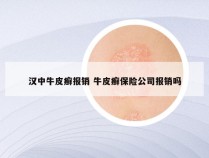 汉中牛皮癣报销 牛皮癣保险公司报销吗