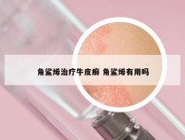 角鲨烯治疗牛皮癣 角鲨烯有用吗