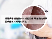 银屑病干细胞什么时候能出来 干细胞治疗银屑病什么时候可以问世