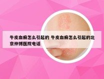 牛皮血癣怎么引起的 牛皮血癣怎么引起的北京仲博医院电话