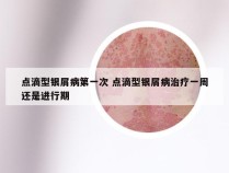 点滴型银屑病第一次 点滴型银屑病治疗一周还是进行期