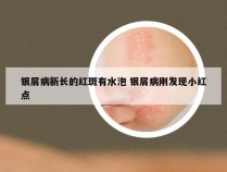 银屑病新长的红斑有水泡 银屑病刚发现小红点