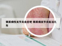 银屑病性关节炎自愈吧 银屑病关节炎能活几年