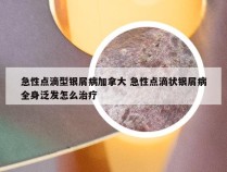 急性点滴型银屑病加拿大 急性点滴状银屑病全身泛发怎么治疗