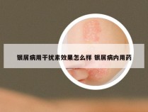 银屑病用干扰素效果怎么样 银屑病内用药