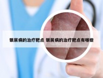 银屑病的治疗靶点 银屑病的治疗靶点有哪些