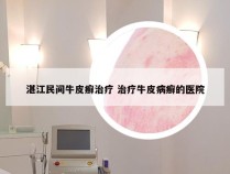 湛江民间牛皮癣治疗 治疗牛皮病癣的医院