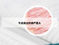 牛皮癣这种病严重么
