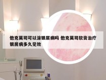 他克莫司可以涂银屑病吗 他克莫司软膏治疗银屑病多久见效
