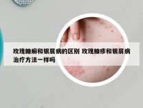 玫瑰糠癣和银屑病的区别 玫瑰糠疹和银屑病治疗方法一样吗