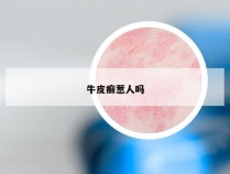 牛皮癣惹人吗