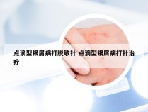 点滴型银屑病打脱敏针 点滴型银屑病打针治疗
