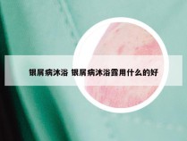 银屑病沐浴 银屑病沐浴露用什么的好