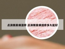 点滴银屑病湿疹 点滴银屑病湿疹多久能好
