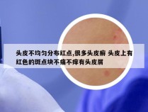头皮不均匀分布红点,很多头皮癣 头皮上有红色的斑点块不痛不痒有头皮屑