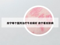 南宁哪个医院治疗牛皮癣好 南宁看皮肤病