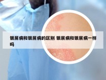 银屑病和银屑病的区别 银屑病和银屑病一样吗