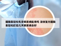 醋酸氟轻松乳膏银屑病能用吗 涂抹复方醋酸氟轻松酊后几天银屑病会好