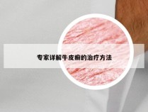 专家详解牛皮癣的治疗方法
