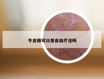 牛皮癣可以用自血疗法吗