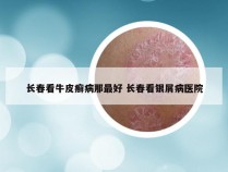 长春看牛皮癣病那最好 长春看银屑病医院