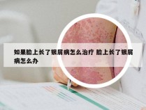如果脸上长了银屑病怎么治疗 脸上长了银屑病怎么办
