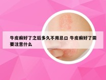 牛皮癣好了之后多久不用忌口 牛皮癣好了需要注意什么