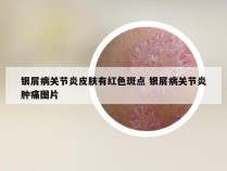 银屑病关节炎皮肤有红色斑点 银屑病关节炎肿痛图片