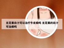 无花果白汁可以治疗牛皮癣吗 无花果的白汁可治癣吗