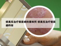 修美乐治疗银屑病效果如何 修美乐治疗银屑病咋样