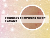 冬季银屑病易复发日常护理看这里 银屑病在冬天怎么保养